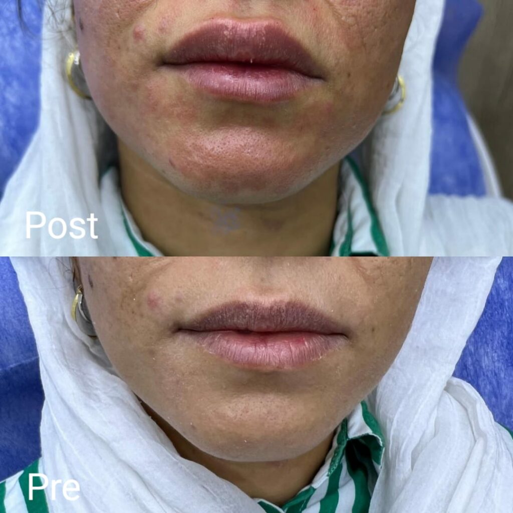 Lip augmentation by lip flip
